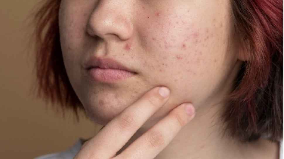 10 Rekomendasi Moisturizer Salicylic Acid: Atasi Jerawat dan Dapatkan Wajah Glowing