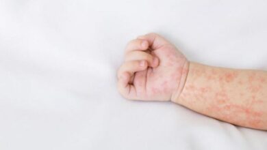 Campak Mewabah: Pentingnya Vaksinasi Anak agar Tidak Terlambat!