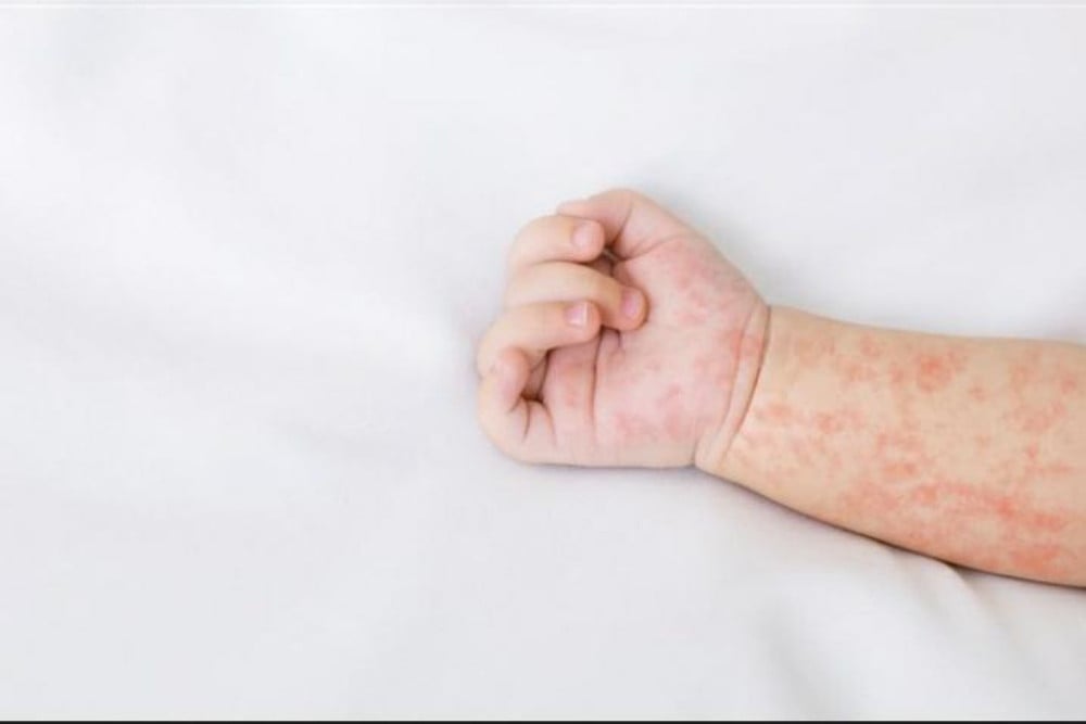 Campak Mewabah: Pentingnya Vaksinasi Anak agar Tidak Terlambat!