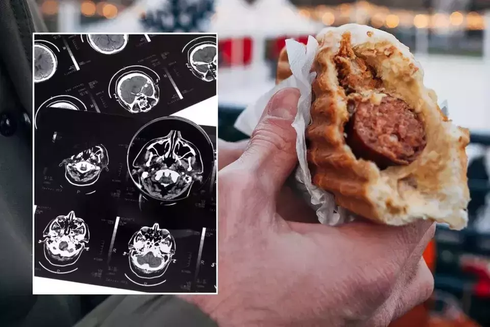 Kebiasaan Makan Daging Olahan Berisiko Picu Demensia Lebih Cepat, Penelitian Ungkap