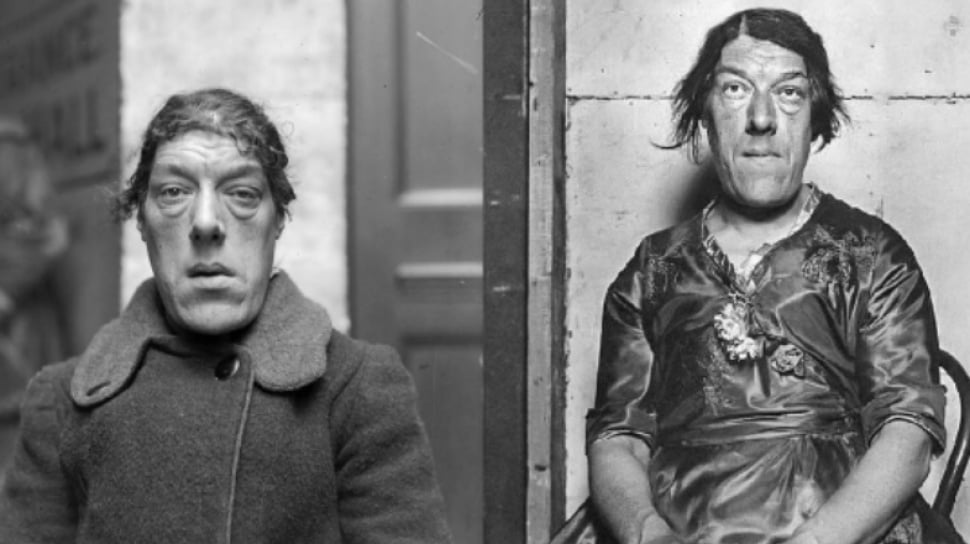 Kisah Pilu Mary Ann Bevan: Perjuangan Wanita Terjelek Menantang Takdir