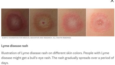 Penyebab dan Ciri Penyakit Lyme yang Menghantui Bella Hadid Sejak 16 Tahun