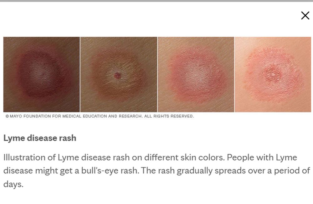 Penyebab dan Ciri Penyakit Lyme yang Menghantui Bella Hadid Sejak 16 Tahun