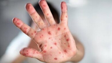 Waspada! 112 Kasus Suspek Campak Ditemukan di Subang, Ikuti Protokol Kesehatan