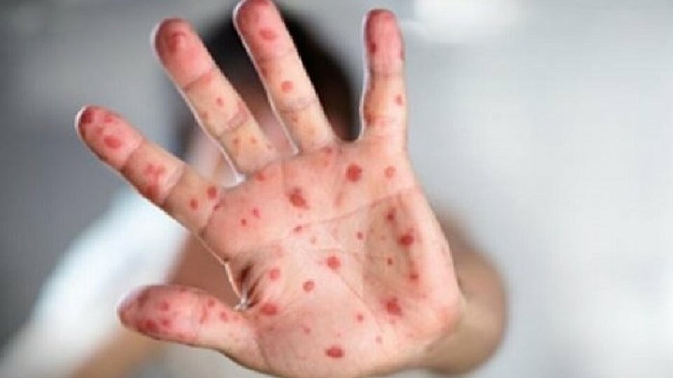 Waspada! 112 Kasus Suspek Campak Ditemukan di Subang, Ikuti Protokol Kesehatan