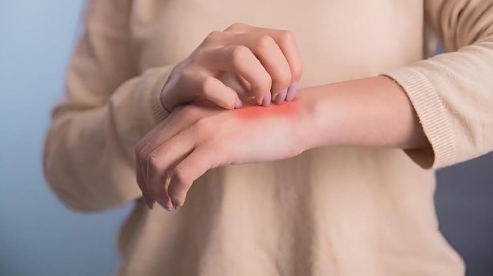 Cuaca Panas Picu Kulit Gatal dan Ruam Merah? Kenali Alergi dan Obat Tepat!