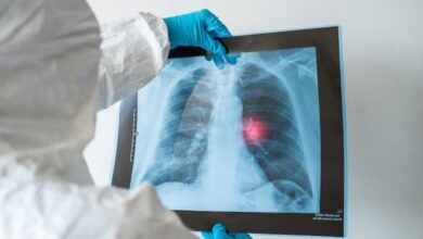 Kasus Kanker Paru Meningkat, Dunia Medis Indonesia Bersiap Adopsi Teknologi Baru