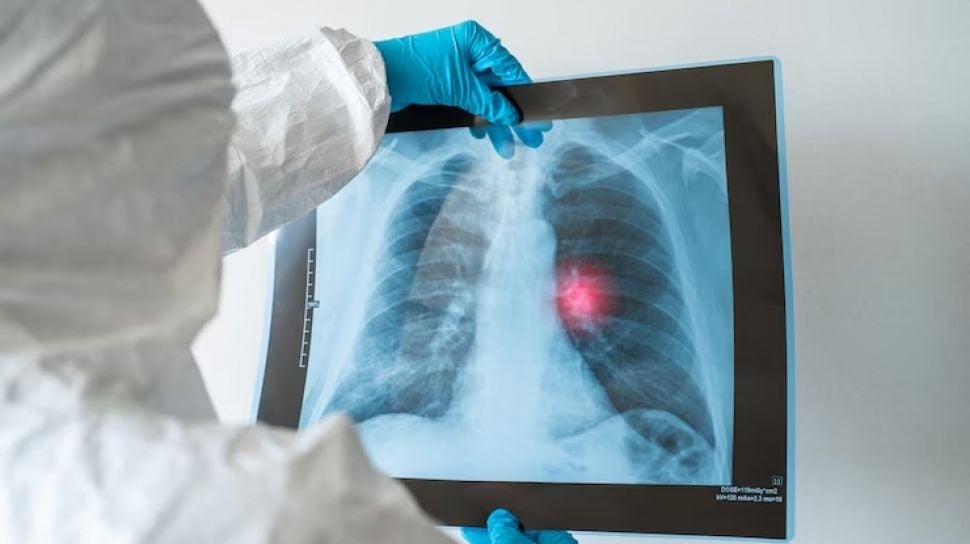 Kasus Kanker Paru Meningkat, Dunia Medis Indonesia Bersiap Adopsi Teknologi Baru