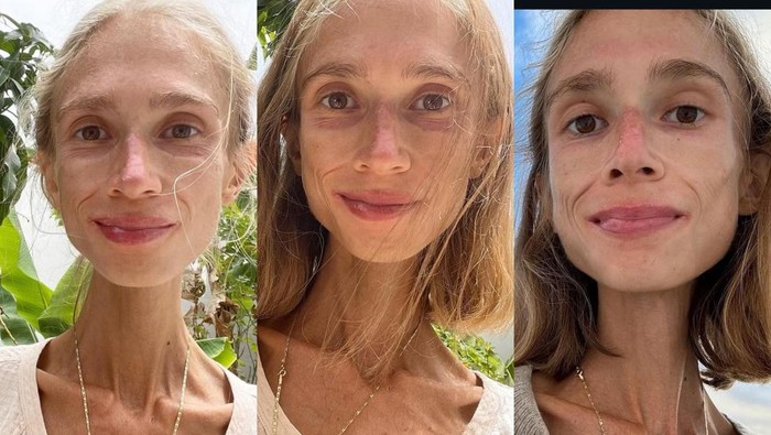 Kondisi Wanita Polandia: 'Mati Kelaparan' di Bali Akibat Diet Buah Ekstrem