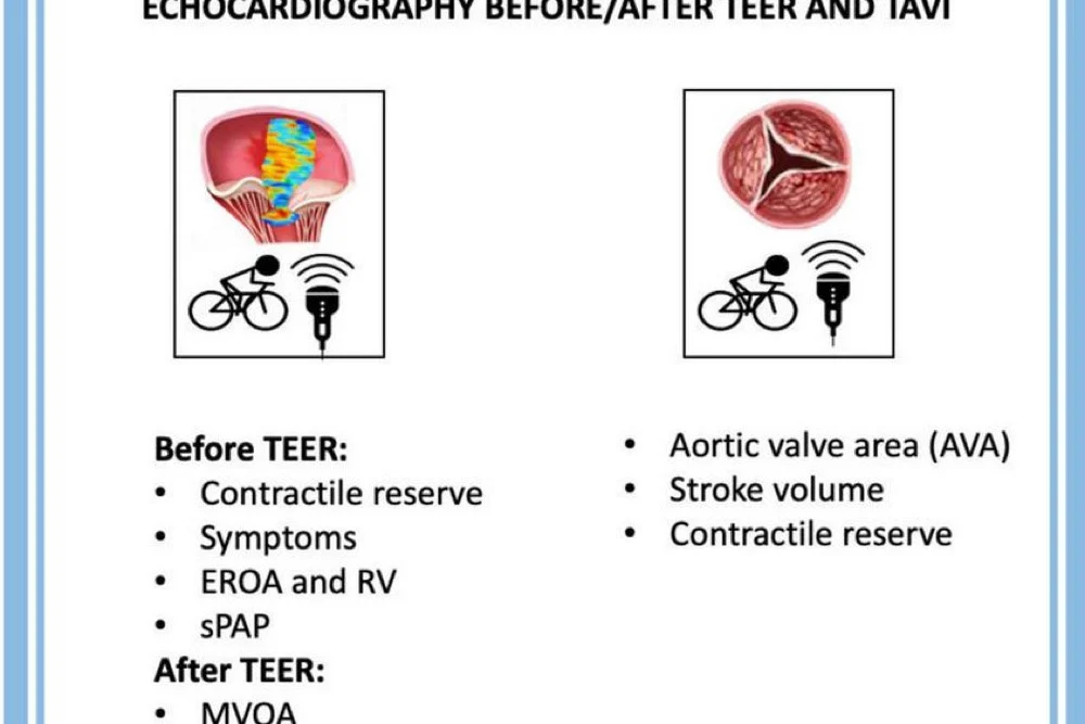 Mengenal TAVI dan TEER: Inovasi Bedah Jantung Minim Invasif Terbaru