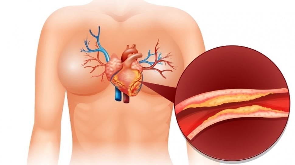 Penyakit Jantung Masih Jadi Pembunuh Utama: Inovasi Tanpa Operasi Besar yang Patut Diketahui