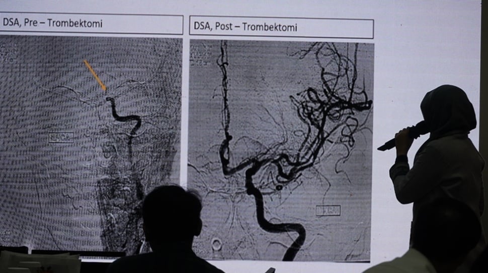 Setiap Detik Berharga: Pentingnya Tindakan Cepat Menyematkan Nyawa Pasien Aritmia dan Stroke