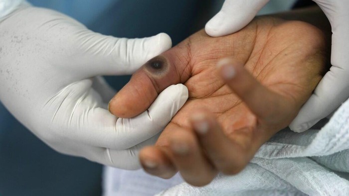 WHO Beri Warning Terkait Varian Mpox 'Clade 1b' yang Merebak di 42 Negara