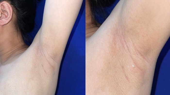 Wanita Miliki 'Puting' Tambahan, ASI Mengalir dari Ketiak! Simak Faktanya!