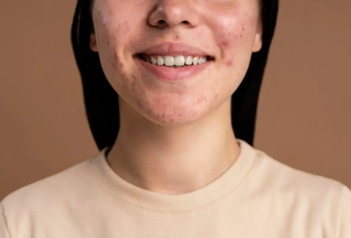 6 Rekomendasi Skincare Ampuh untuk Atasi Jerawat Batu, Simak Tips Perawatannya