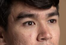 Langkah Efektif Mengatasi Milia di Wajah untuk Kulit Cerah dan Sehat Secara Alami