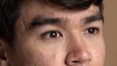 Langkah Efektif Mengatasi Milia di Wajah untuk Kulit Cerah dan Sehat Secara Alami