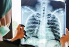 RS XYZ Datangkan Pakar Dunia Hadapi Tantangan Kompleks Bedah Bahu: Solusi Terbaru!